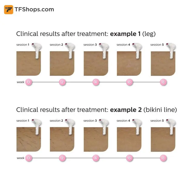 دستگاه لیزر بدن لومه آ فیلیپس